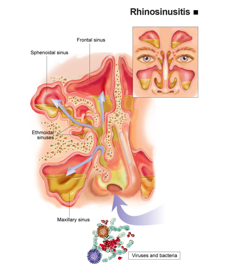 Infografis rhinosinusitis
